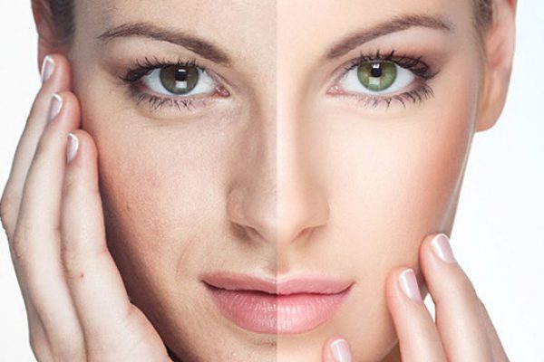 lazernoe-omolozhenie