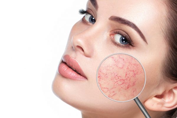 rosacea