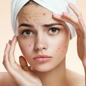 мертвое-море-акне-750×445 мертвое-море-акне-750x445